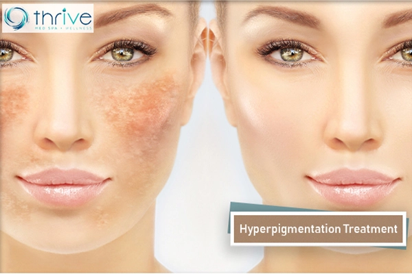 Hyperpigmentation Treatment Portsmouth NH