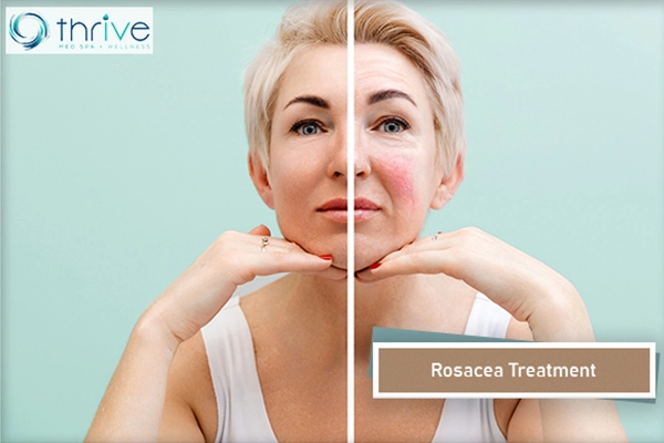 Rosacea Treatment Portsmouth NH