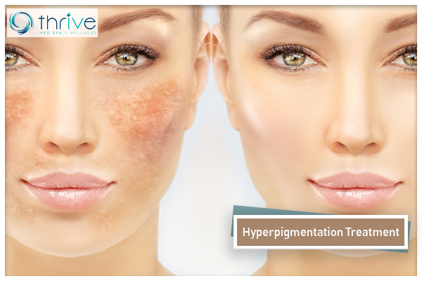 Hyperpigmentation Treatment Portsmouth NH