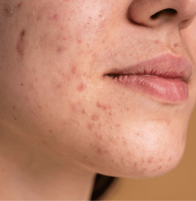 Medical Spa in Portsmouth, NH: Acne Scar Removal Banner