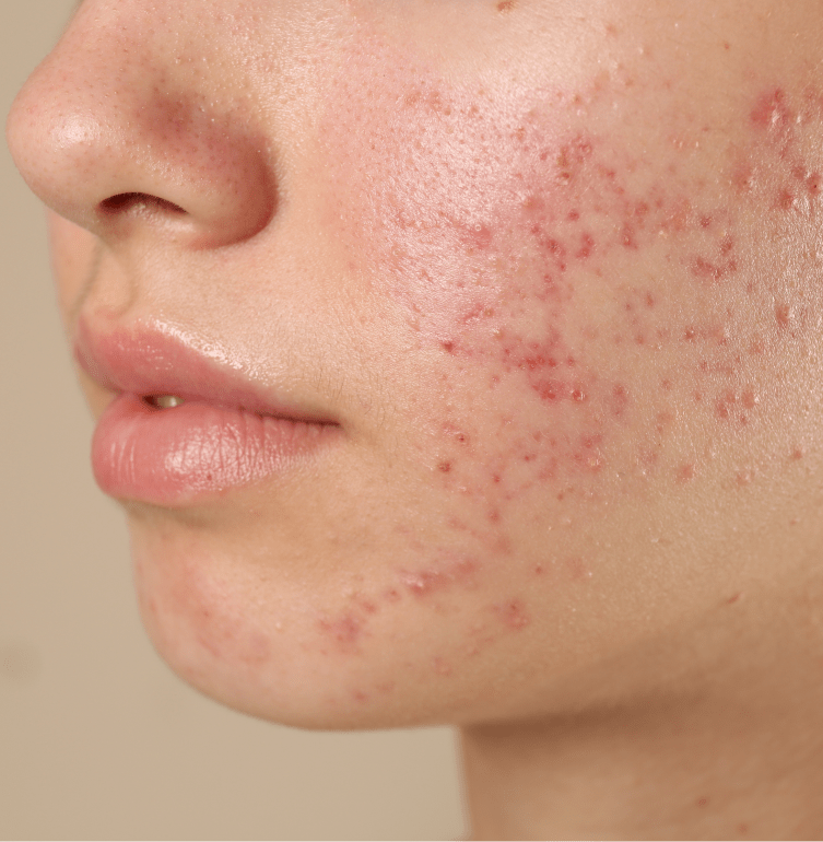 Portsmouth NH Medical Spa: Acne Treatment Banner