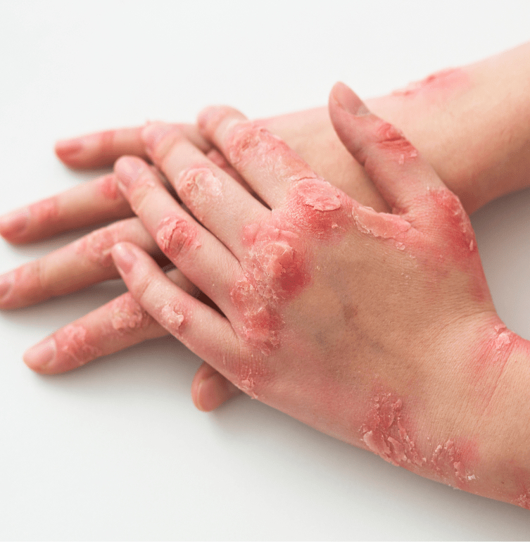 Portsmouth NH Medical Spa: Psoriasis Treatment Banner