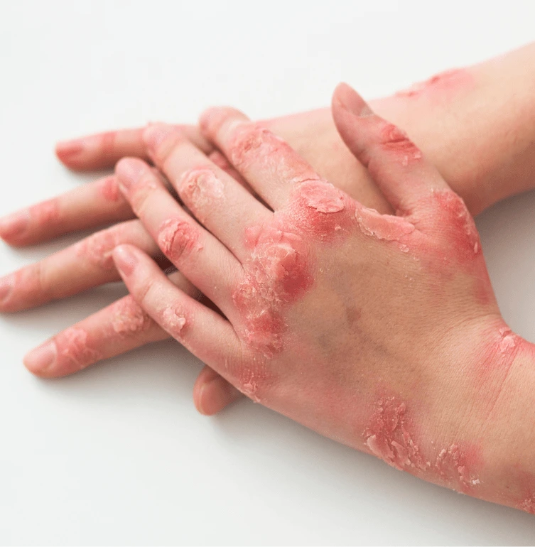 Portsmouth NH Medical Spa: Psoriasis Treatment Banner