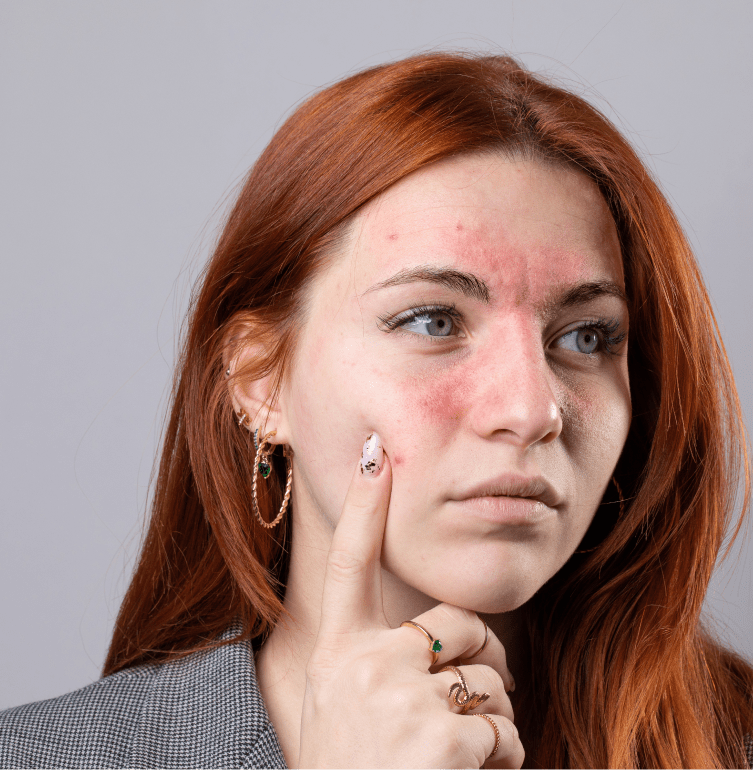 Medical Spa Portsmouth NH: Rosacea Treatment Banner
