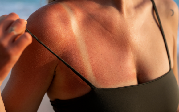 Health Conditions in Portsmouth NH: Sun Damage Banner
