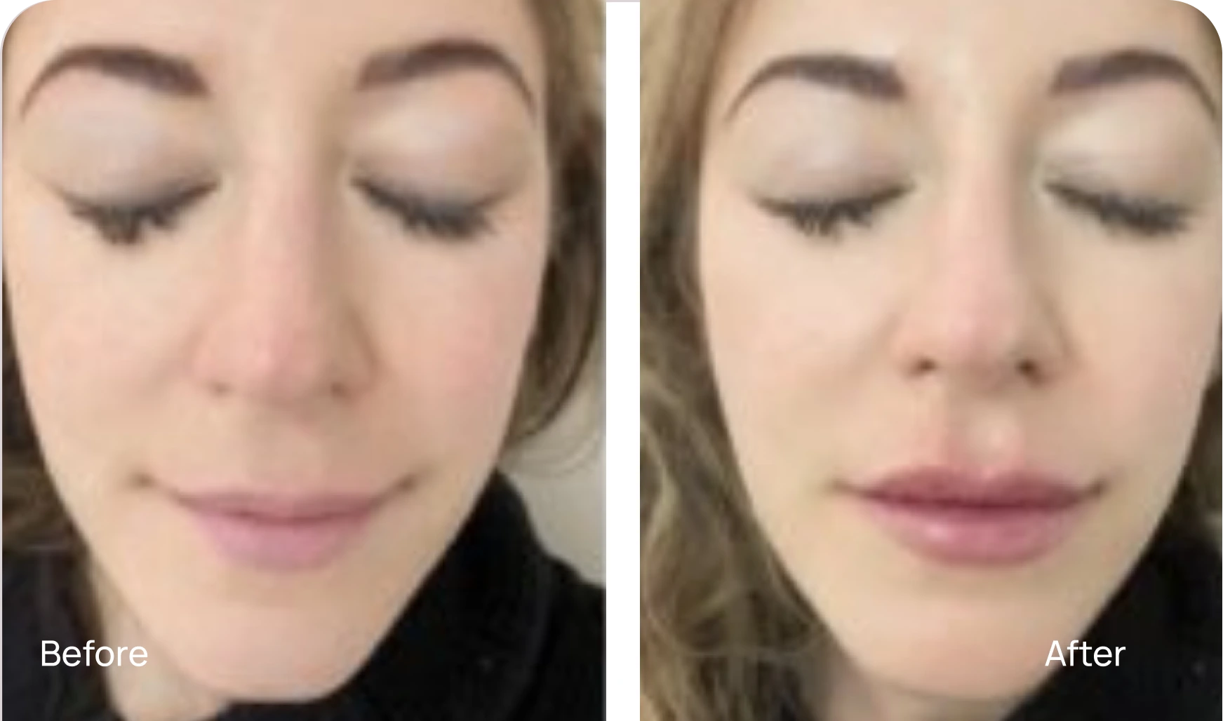 Lip Fillers - Case 19